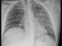 fever-pneumonia-diagnosis-sehat-11723663578.jpg