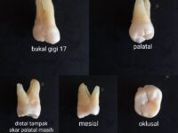 gigi-geraham-molar-sehat-11723807138.jpg